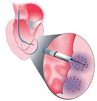 NOGA-catheder